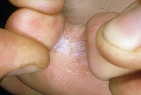 Jendearen terapia